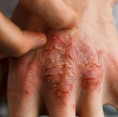 Zaujalo nás. Ide o viac než len svrbenie: Pri liečbe ekzémov je nutné zmeniť stratégiu